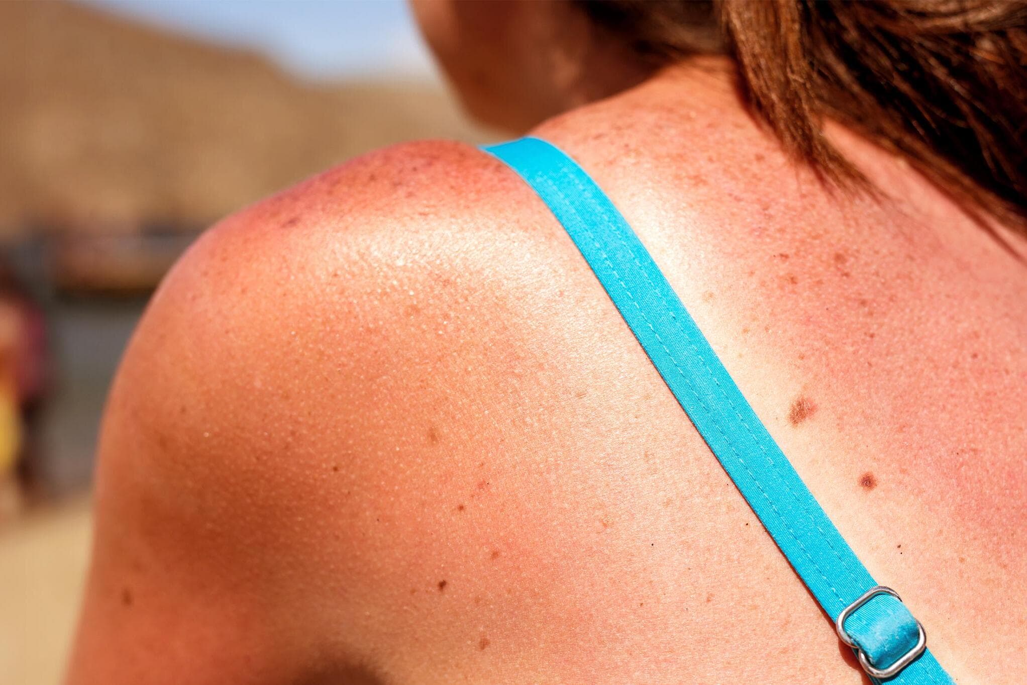 Sunburnt and sleep deprived? How to reboot your body before Fall hits